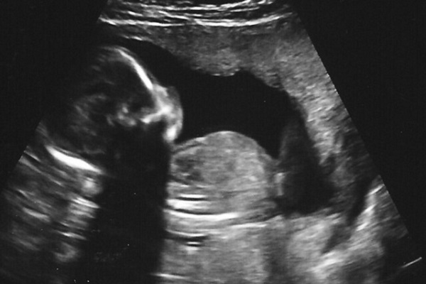 When Christians argue for abortion