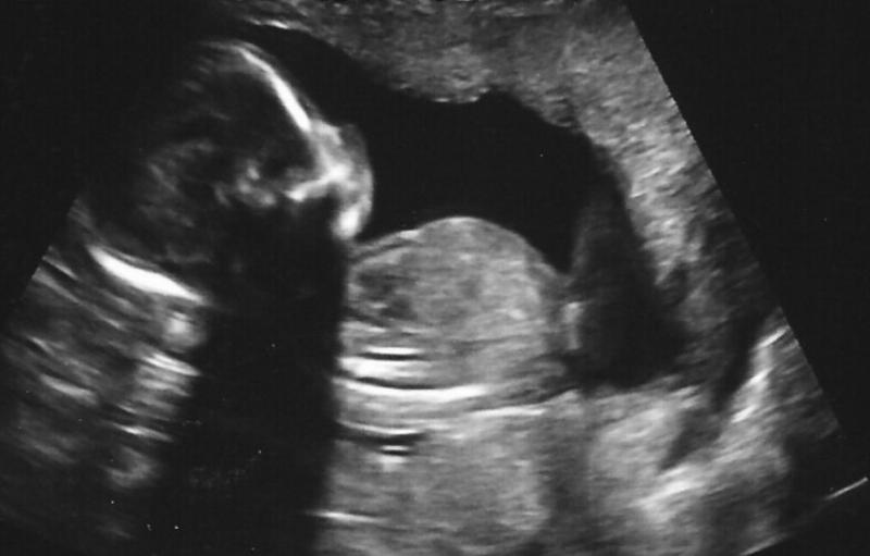 NextImg:Abortion language to assuage the conscience